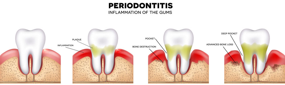 periodontal-gum-treatment-fan-mou-smile-dental